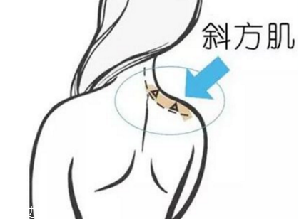 瘦肩針間隔多久打一次？打瘦肩針間隔時(shí)間
