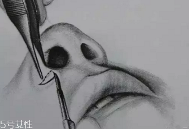 鼻翼外切多久消腫？鼻翼外切消腫時(shí)間要多長(zhǎng)？