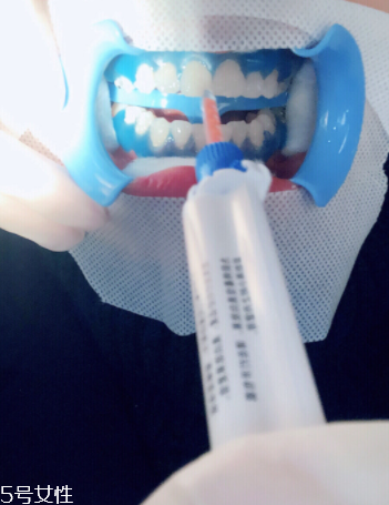 冷光美白會反彈嗎？冷光美白心得