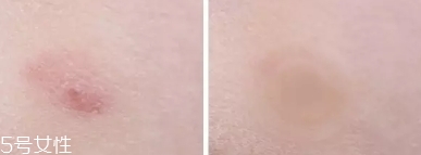 vt痘痘貼怎么用？vt老虎痘痘貼防水嗎