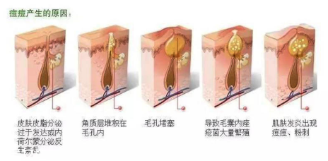 頑固痘痘怎么消除？油皮為什么反復爆痘？
