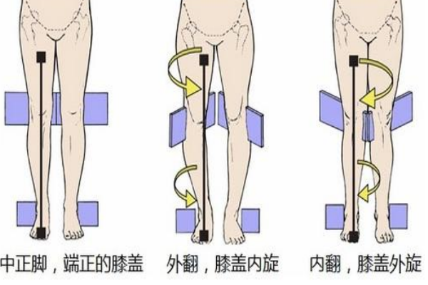 膝蓋超伸可以恢復嗎 可以通過鍛煉改善