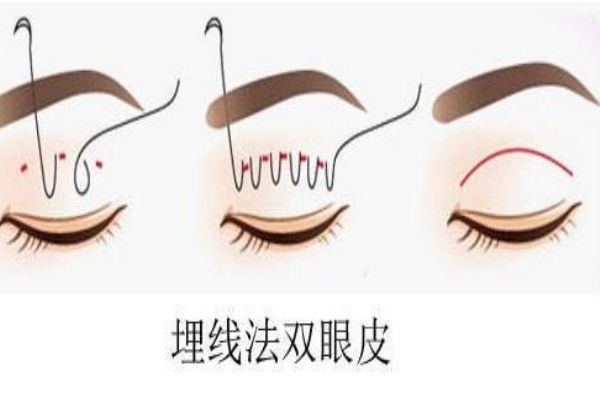 埋線雙眼皮感染怎么辦？埋線雙眼皮發(fā)炎了怎么辦