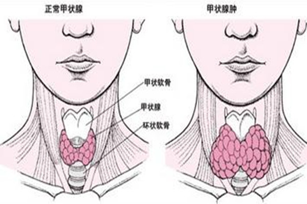 甲狀腺結(jié)節(jié)會導(dǎo)致脖子疼嗎 甲狀腺結(jié)節(jié)有什么癥狀