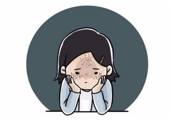 怎么樣去除黃褐斑曬斑 曬斑雀斑黃褐斑的區(qū)別