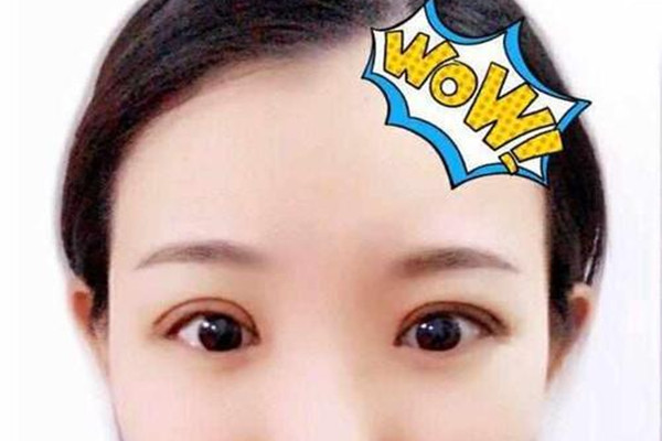 為什么壓雙眼皮看起來有緊繃感 術后眼睛要做哪些運動