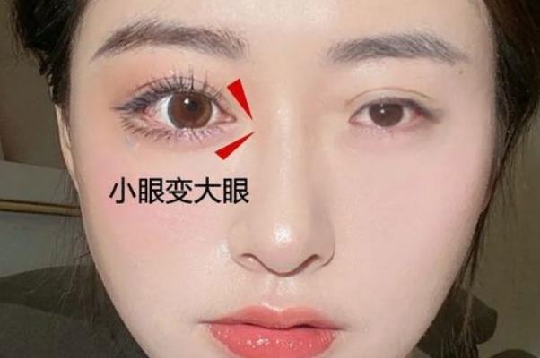 開(kāi)眼角手術(shù)一般需要多少錢(qián) 開(kāi)眼角手術(shù)危險(xiǎn)嗎