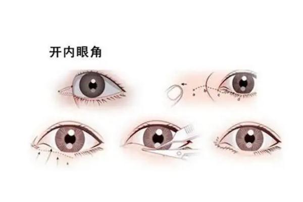 開(kāi)眼角手術(shù)一般需要多少錢(qián) 開(kāi)眼角手術(shù)危險(xiǎn)嗎