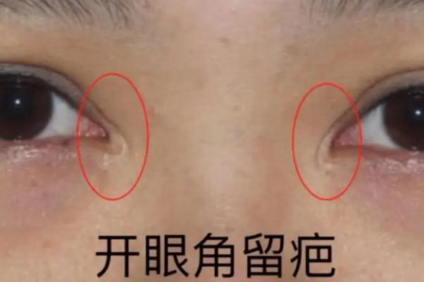 開(kāi)眼角手術(shù)一般需要多少錢(qián) 開(kāi)眼角手術(shù)危險(xiǎn)嗎
